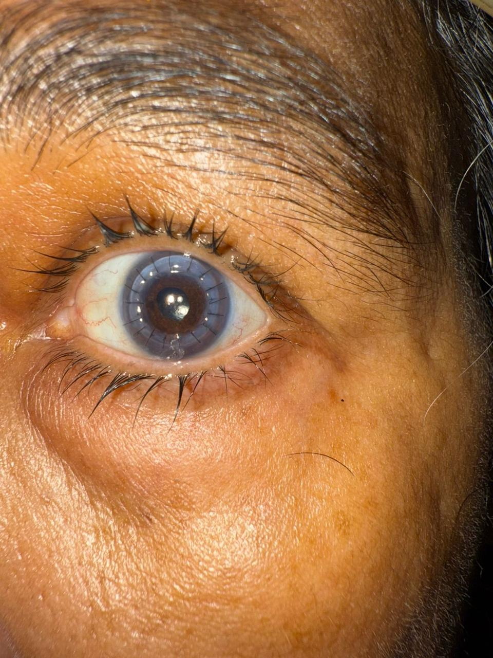 After Treatment
